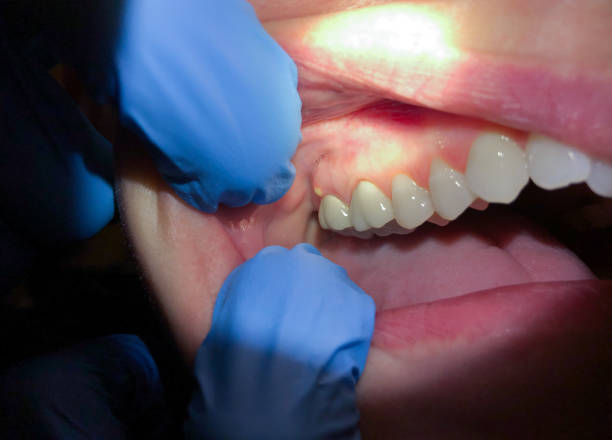 Tooth Infection Emergency Dentist in FL